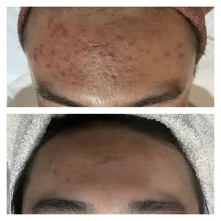 【赤ニキビ改善】 BELL'ET新宿店のエステ・リラクイメージ