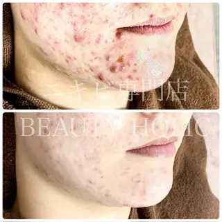 ニキビ・ 肌荒れ専門店のエステ・リラクイメージ