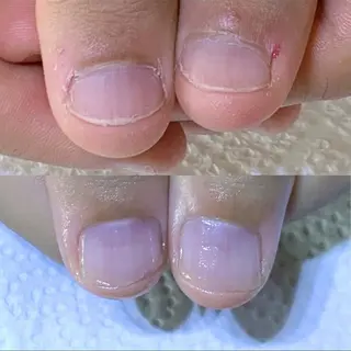 ネイル 自爪育成/深爪矯正 mikiのネイルデザイン