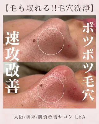 Lea堺東　毛穴洗浄 ×顔ワックス脱毛のその他イメージ
