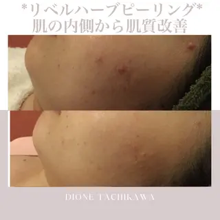 【リベルハーブピーリング認定店】敏感肌・美白脱毛専門店Dione立川店所属・Dione 立川店のエステ・リラクイメージ