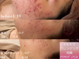 【ニキビ/肌管理】 salon varyのエステ・リラクイメージ