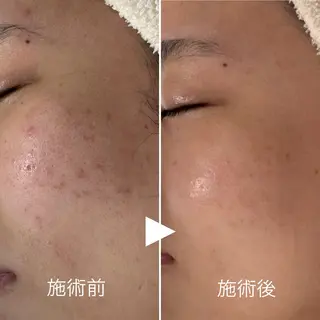 ニキビ・毛穴・ フェイシャル専門店のエステ・リラクイメージ