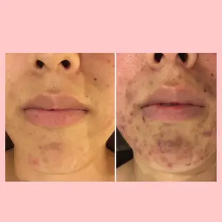 セミロング カラー パーマ ヘアアレンジ メンズ キッズ ネイル マツエク・マツパ 3か月で肌革命👼 ニキビ専門店💫のエステ・リラクイメージ