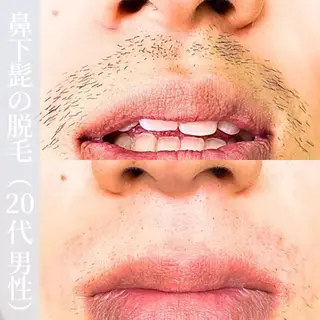 メンズ 【一本ずつ脱毛】 ReMove 柏のエステ・リラクイメージ