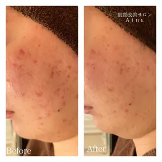ショート カラー パーマ ヘアアレンジ メンズ キッズ ネイル マツエク・マツパ ニキビ跡専門サロン Ainaのエステ・リラクイメージ