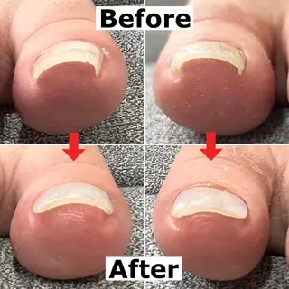 ネイル 巻爪無料モデル募集 ✨🦶MEGUMIのネイルデザイン
