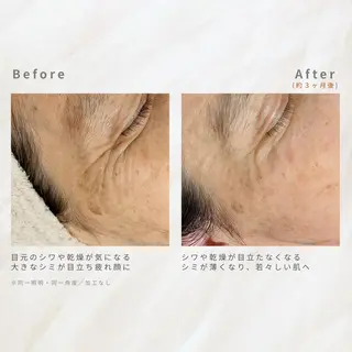 繰り返すニキビ・毛穴 ✨つくば肌質改善専門のエステ・リラクイメージ