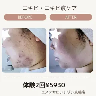 ニキビケア◇ニキビ跡 レゾン京橋店 峠山のエステ・リラクイメージ