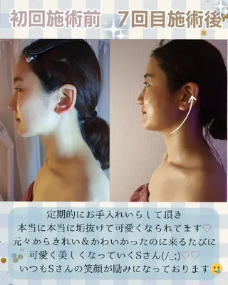 痩身ハーブピーリング 筋膜リリース☆B&Hのエステ・リラクイメージ
