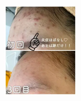 ミディアム カラー パーマ ヘアアレンジ メンズ キッズ ネイル マツエク・マツパ ニキビ&跡改善サロン オーナー光木のエステ・リラクイメージ