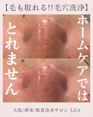 Lea堺東　毛穴洗浄 ×顔ワックス脱毛のその他イメージ