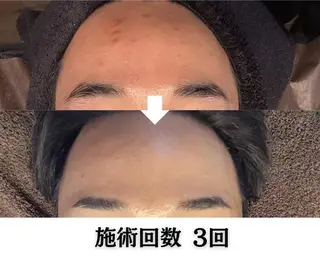 池袋ニキビ毛穴改善 🌿ハーブピーリングのエステ・リラクイメージ