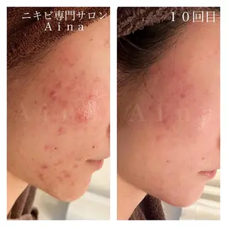 セミロング パーマ ヘアアレンジ メンズ キッズ ネイル マツエク・マツパ ニキビ跡専門サロン Ainaのエステ・リラクイメージ