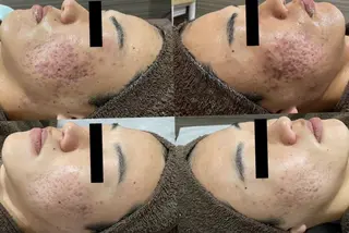 毛穴ケア くすみ肌 ハーブピーリングのエステ・リラクイメージ