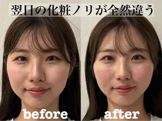 肌質改善×美容鍼 ゆいのエステ・リラクイメージ