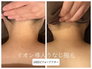 🎀うなじ脱毛🎀 ㅣLino堀江のエステ・リラクイメージ