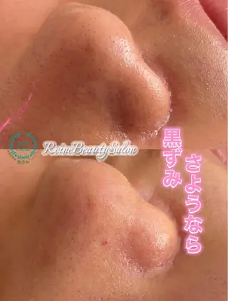 毛穴/シミ肝斑/脱毛 横山梨里のエステ・リラクイメージ