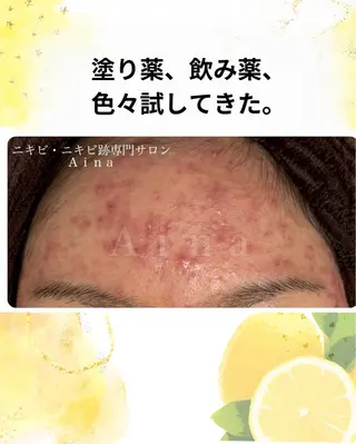 ニキビ跡専門サロン Ａｉｎａのエステ・リラクイメージ