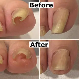 ネイル Mellow nail所属・巻爪無料モデル募集 ✨🦶MEGUMIのネイルデザイン