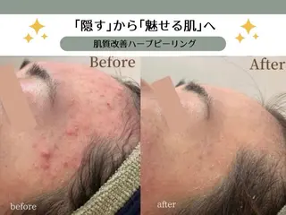 VIKI BEAUTY  クレイハーブピーリング・美肌脱毛専門店所属・VIKI BEAUTYのエステ・リラクイメージ