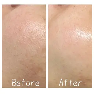 Charme coco(シャルム ココ)八尾店所属・ニキビ 毛穴ケア シャルム ココ みさのエステ・リラクイメージ