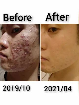 【赤ニキビ改善】 BELL'ET新宿店のエステ・リラクイメージ