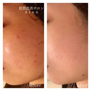 セミロング カラー パーマ ヘアアレンジ メンズ キッズ ネイル マツエク・マツパ ニキビ跡専門サロン Ainaのエステ・リラクイメージ