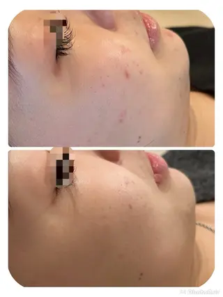 【リベルハーブピーリング認定店】敏感肌・美白脱毛専門店Dione立川店所属・Dione 立川店のエステ・リラクイメージ