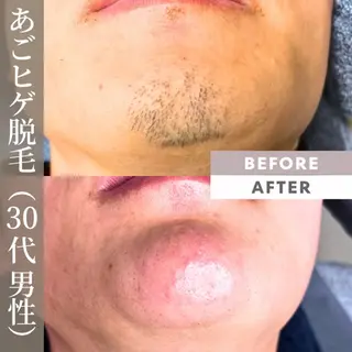 メンズ 【一本ずつ脱毛】 ReMove 柏のエステ・リラクイメージ