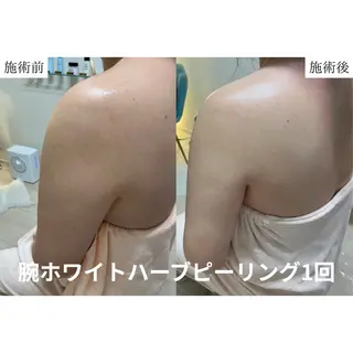 【ハーブピーリング】 Allumentのエステ・リラクイメージ