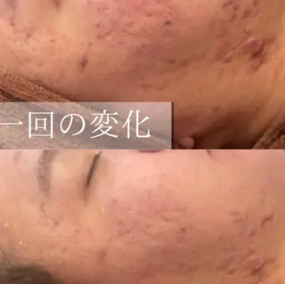セミロング カラー パーマ ヘアアレンジ メンズ キッズ ネイル マツエク・マツパ アイブロウ 3か月で肌革命👼 ニキビ専門店💫のエステ・リラクイメージ