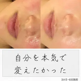 ニキビ経験者が施術 する専門サロン🌻のエステ・リラクイメージ
