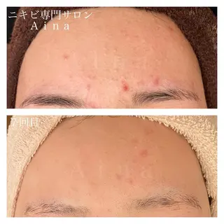 セミロング パーマ ヘアアレンジ メンズ キッズ ネイル マツエク・マツパ ニキビ跡専門サロン Ainaのエステ・リラクイメージ