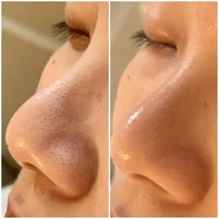 全身脱毛/韓国ツヤ肌 ハーブピーリングのエステ・リラクイメージ