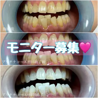 ネイル/耳つぼ /新ホワイトニングのネイルデザイン