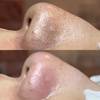 ielu〜毛穴ケア ハーブピーリングのエステ・リラクイメージ