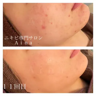 ミディアム カラー パーマ ヘアアレンジ メンズ キッズ ネイル マツエク・マツパ ニキビ跡専門サロン Ainaのエステ・リラクイメージ