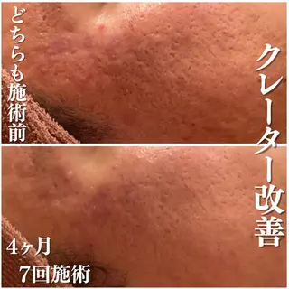 3か月で肌革命👼 ニキビ専門店💫のエステ・リラクイメージ
