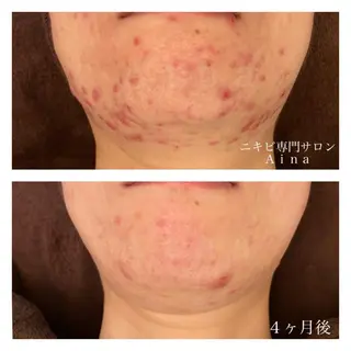 ミディアム カラー パーマ ヘアアレンジ メンズ キッズ ネイル マツエク・マツパ ニキビ跡専門サロン Ainaのエステ・リラクイメージ