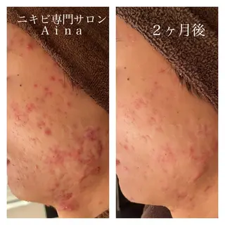 ロング カラー パーマ ヘアアレンジ メンズ キッズ ネイル マツエク・マツパ ニキビ跡専門サロン Ainaのエステ・リラクイメージ
