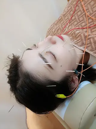 リフトアップ・たるみ ☆美容鍼小顔矯正のその他イメージ