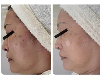 〈ニキビケアサロン〉 レゾン京橋店/ 浅川のエステ・リラクイメージ