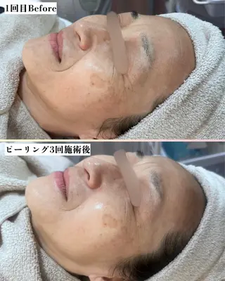 |ピーリング・毛穴| soina神楽坂のエステ・リラクイメージ