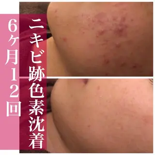 3か月で肌革命👼 ニキビ専門店💫のエステ・リラクイメージ