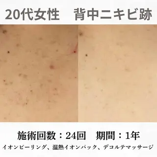 重度ニキビ専門🌷 ダウンタイムなしのエステ・リラクイメージ