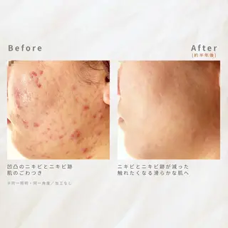 繰り返すニキビ・毛穴 ✨つくば肌質改善専門のエステ・リラクイメージ