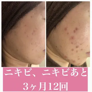 セミロング カラー パーマ ヘアアレンジ メンズ キッズ ネイル マツエク・マツパ アイブロウ 3か月で肌革命👼 ニキビ専門店💫のエステ・リラクイメージ