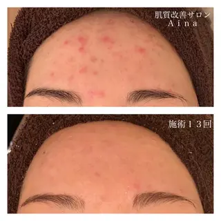 ミディアム カラー パーマ ヘアアレンジ メンズ キッズ ネイル マツエク・マツパ ニキビ跡専門サロン Ainaのエステ・リラクイメージ