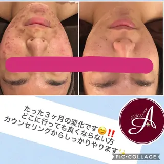 ミディアム パーマ ヘアアレンジ メンズ キッズ ネイル マツエク・マツパ ニキビ・肌質改善専門 ♡人生が変わるサロンのエステ・リラクイメージ